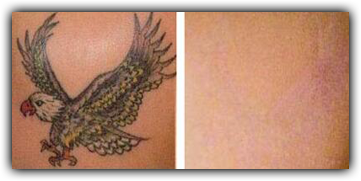 detatouage
